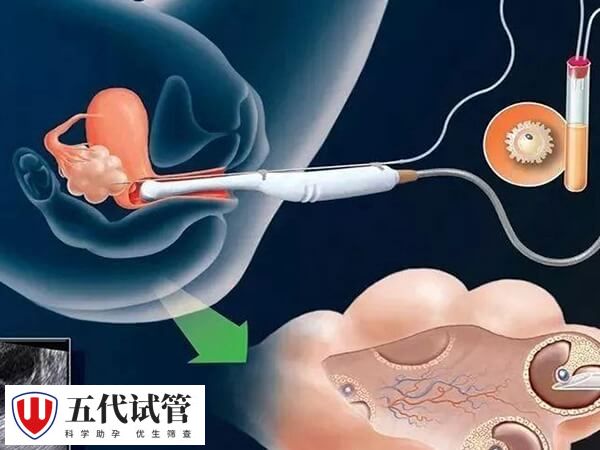 试管婴儿取卵方式有几种