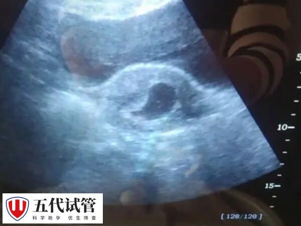 试管孕囊偏小怎么补救